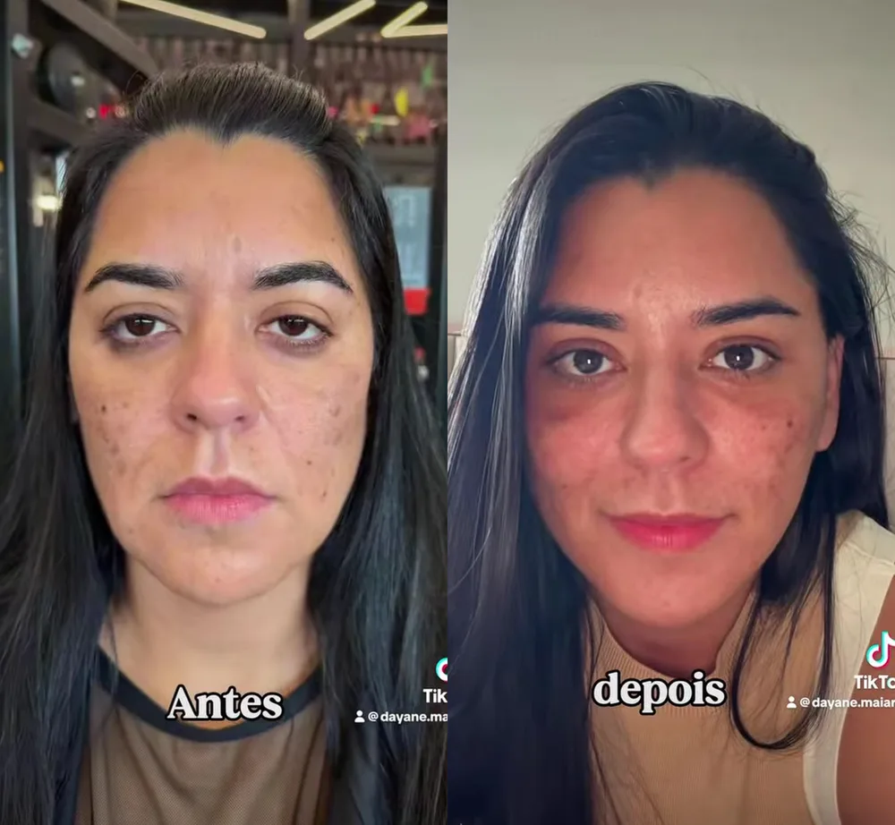 Antes e depois de lifting facial endoscópico